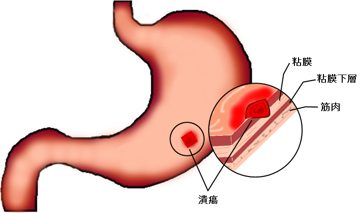 胃潰瘍・十二指腸潰瘍